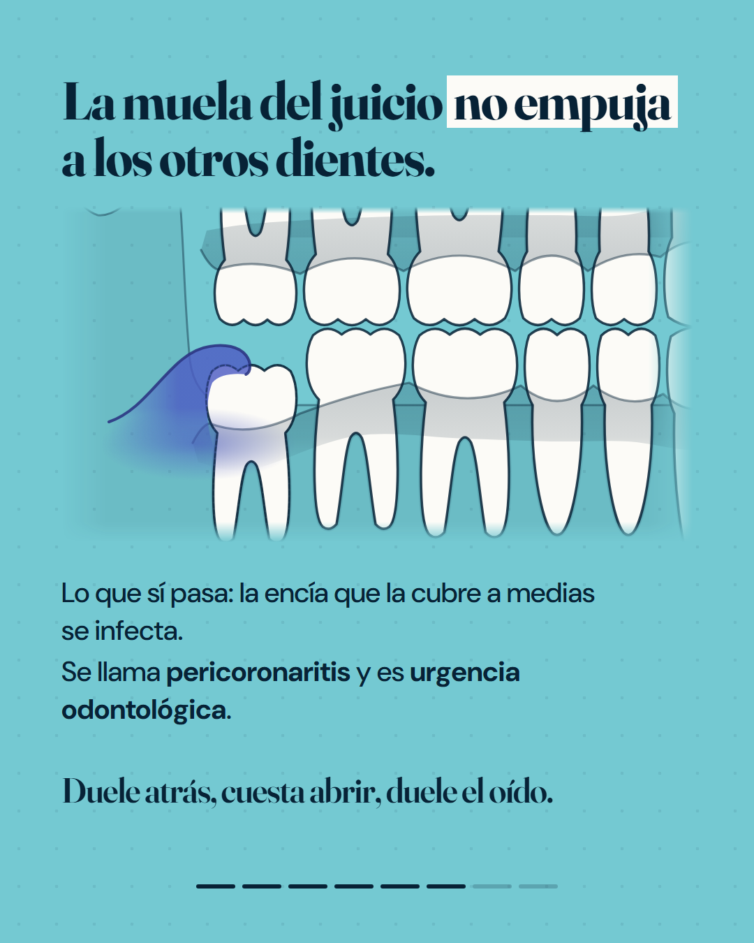 La muela del juicio no empuja a los otros dientes; lo que se inflama es la encía que la cubre a medias.